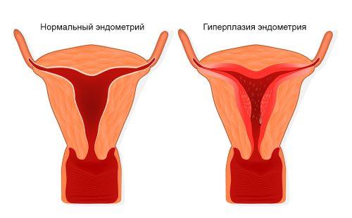 Схема разрастания ткани эндометрия