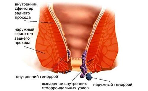 Схематическое изображение заболевания