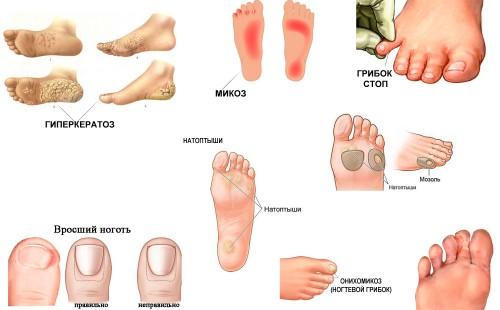 Гиперкератоз стоп,микоз стоп,грибок стоп,натоптыши,ногтевой грибок,вросший ноготь